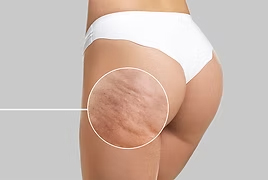 cellulite