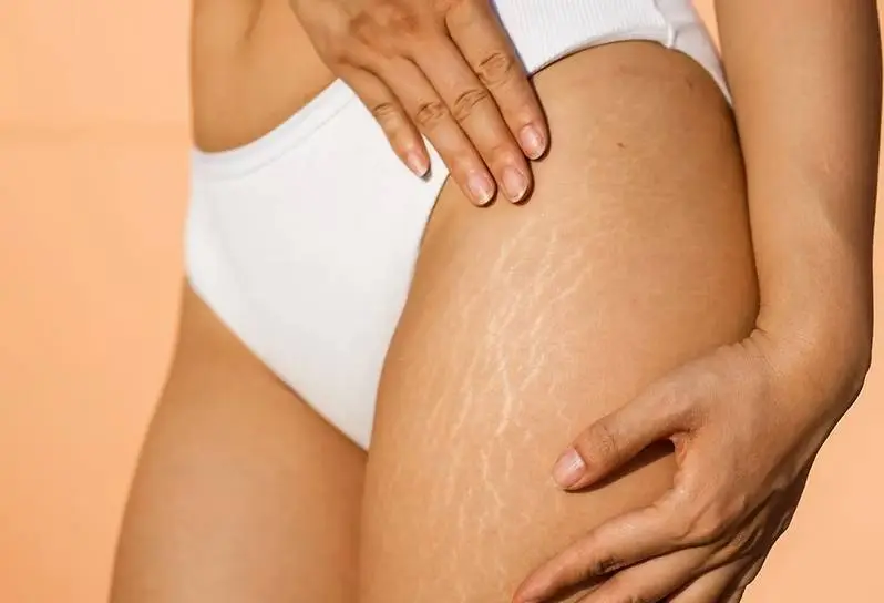 Stretch_Marks_2 Stretch Marks